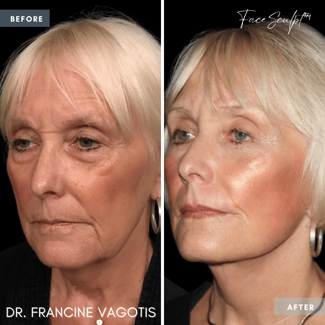 facelift-before-after-photos-chicago-facesculpt-dr-francine-vagotis