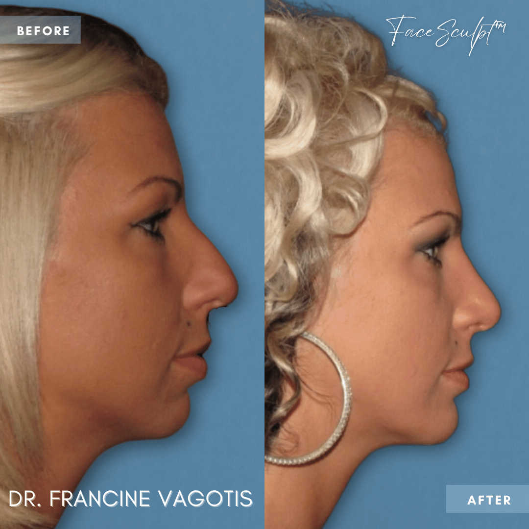 rhinoplasty-nose-job-before-and-after-photos-rhinoplasty-chicago-near-me-facesculpt