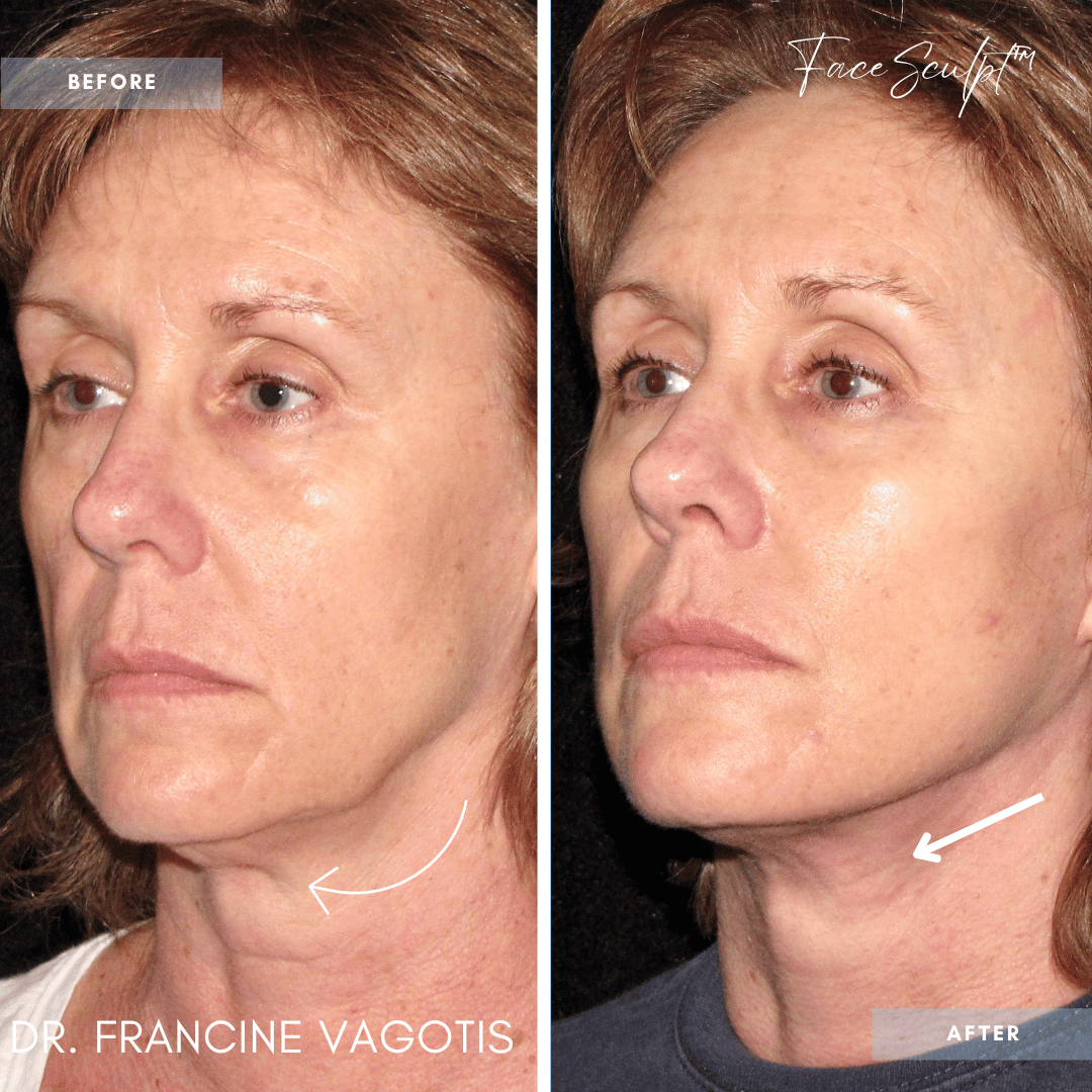 facelift-before-after-photos-chicago-facesculpt-dr-francine-vagotis