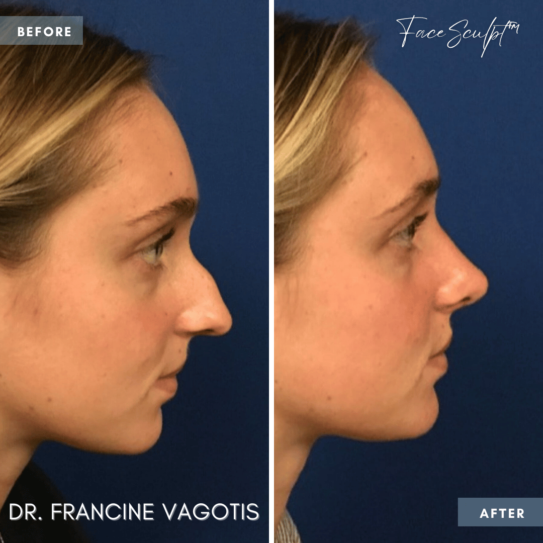 rhinoplasty-nose-job-before-and-after-photos-rhinoplasty-chicago-facesculpt