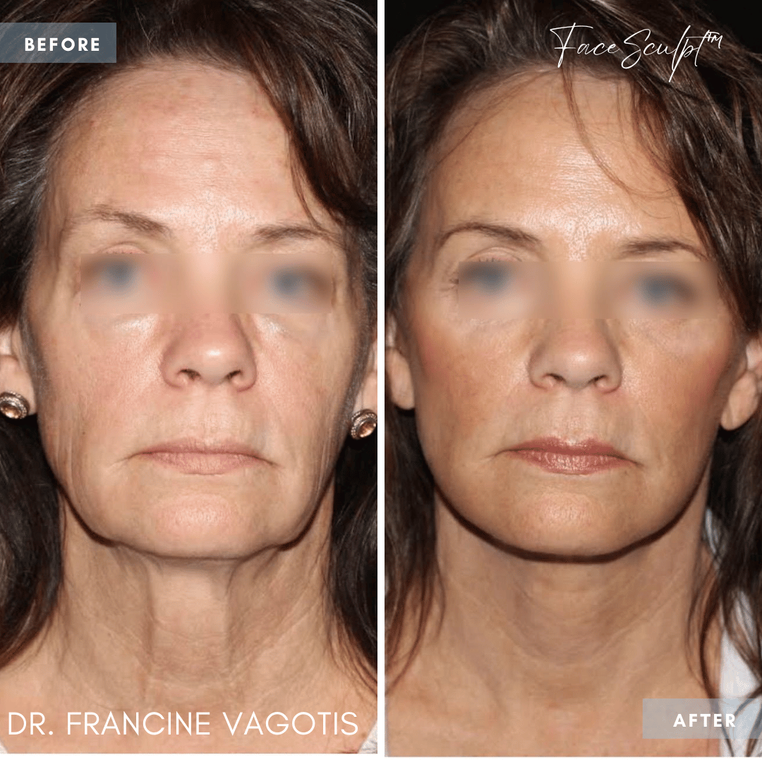 neck-lift-neck-liposuction-surgery-before-after-photos-chicago-dr-francine-vagotis-facesculpt