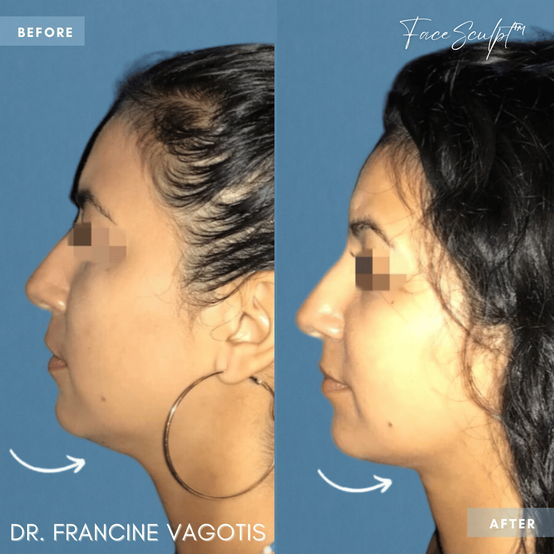 neck-lift-neck-liposuction-surgery-before-after-photos-chicago-dr-francine-vagotis-facesculpt