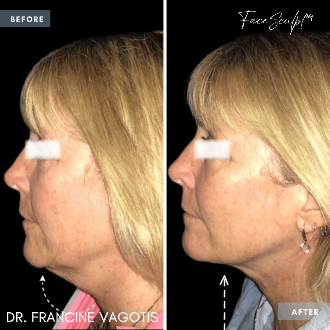 neck-lift-neck-liposuction-surgery-before-after-photos-chicago-dr-francine-vagotis-facesculpt