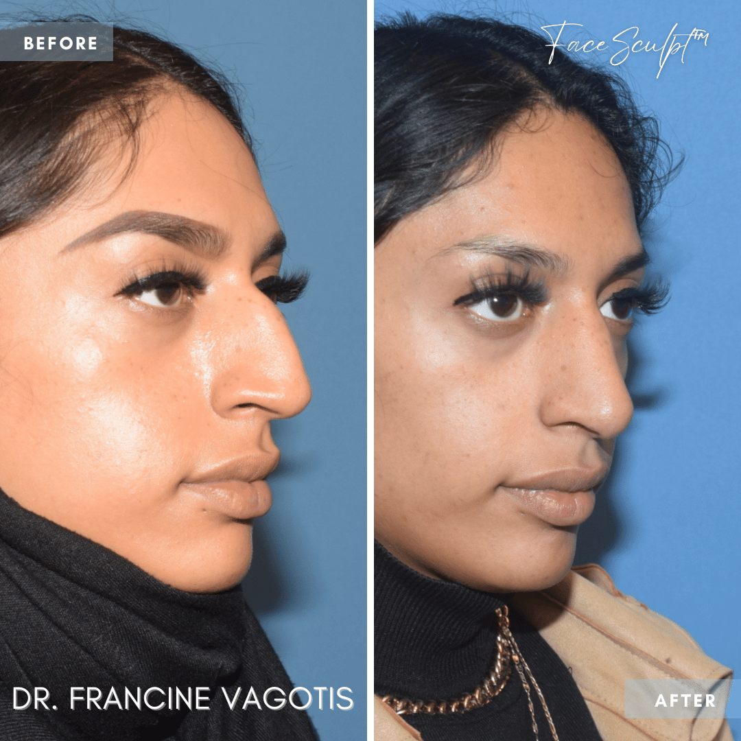 rhinoplasty-nose-job-before-and-after-photos-rhinoplasty-chicago-facesculpt