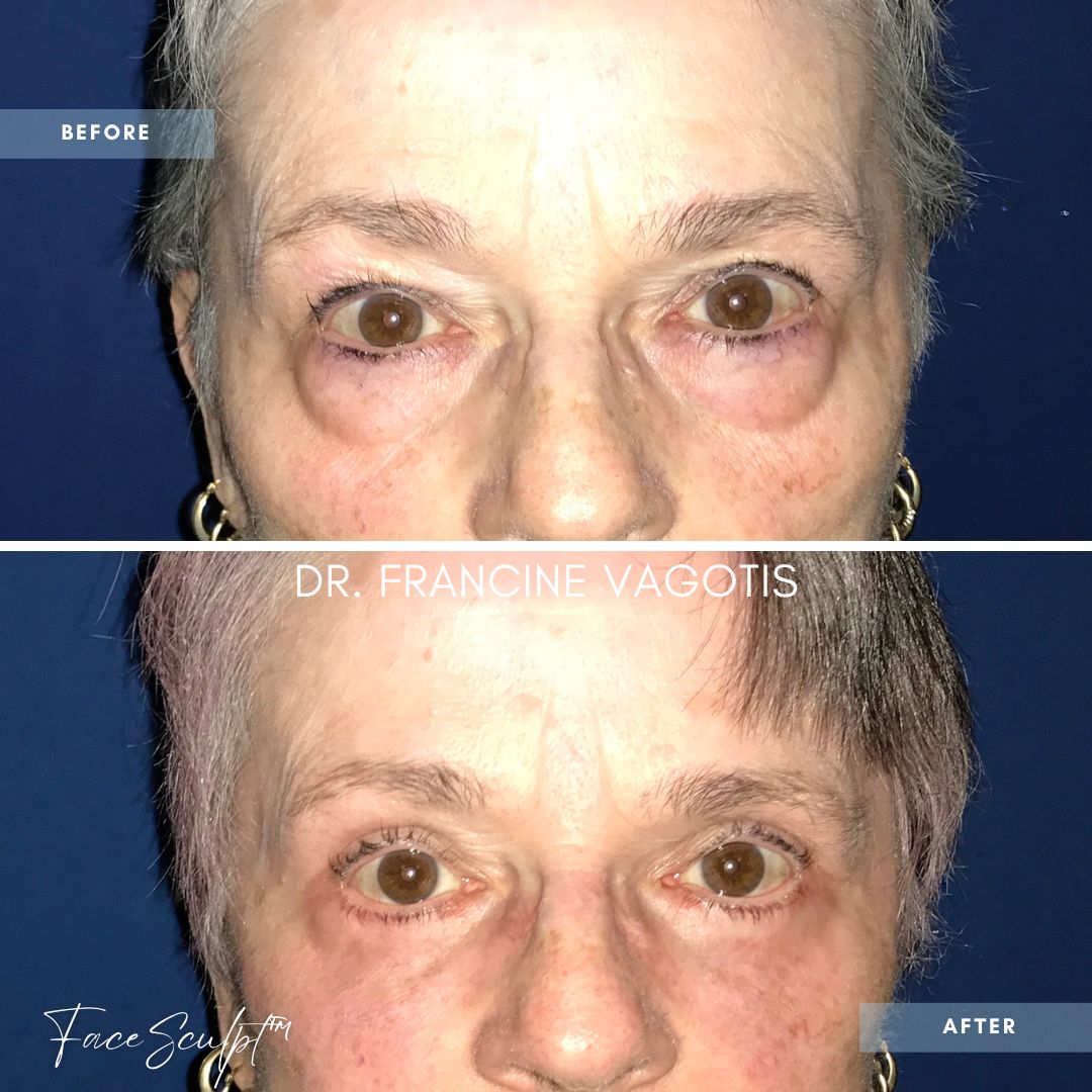 Before and after photo of blepharoplasty surgery by Dr. Francine Vagotis FaceSculpt plastic surgery