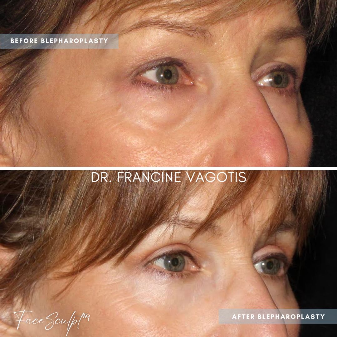 Before and after photo of blepharoplasty surgery by Dr. Francine Vagotis FaceSculpt plastic surgery