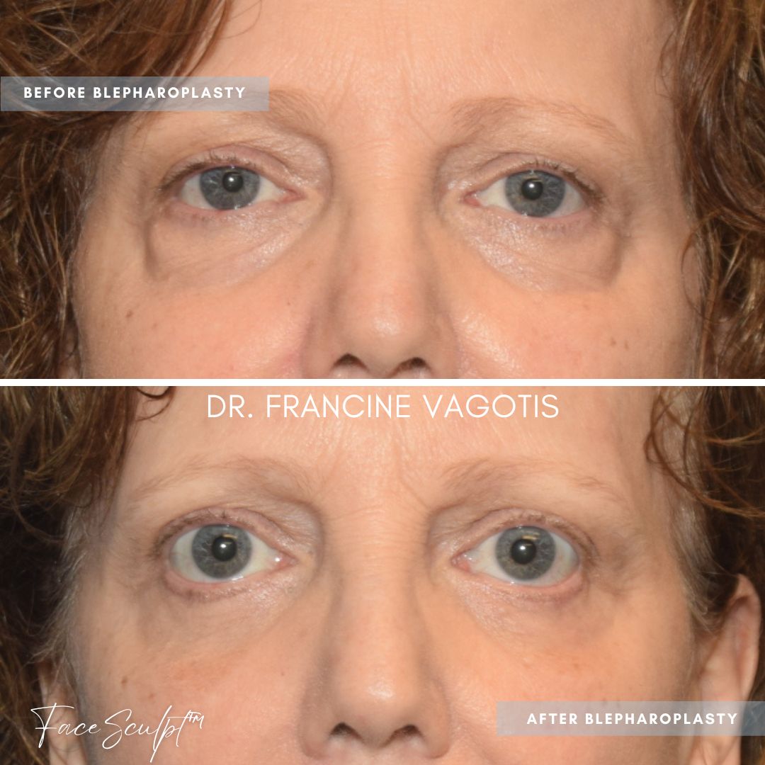 Before and after photo of blepharoplasty surgery by Dr. Francine Vagotis FaceSculpt plastic surgery