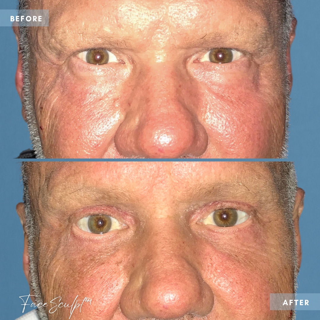 coronal-brow-lift-surgery-dr-francine-vagotis-before-after-chicago-facesculpt