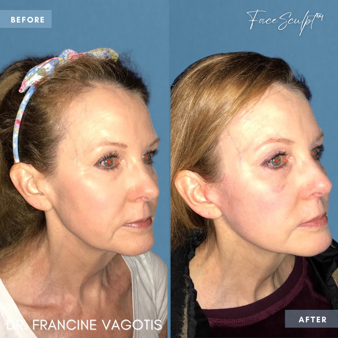 mini-facelift-surgery-before-after-dr-francine-vagotis-facesculpt-facial-plastic-surgery-chicago