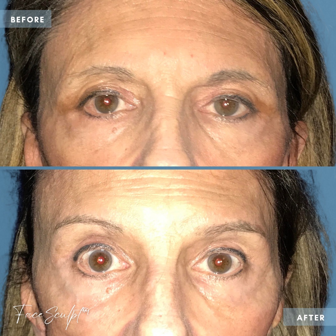 limited-incision-brow-lift-surgery-dr-francine-vagotis-before-after-chicago-facesculpt