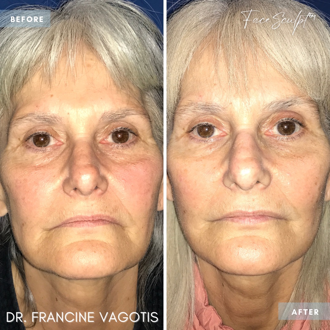 mini-facelift-surgery-before-after-dr-francine-vagotis-facesculpt-facial-plastic-surgery-chicago