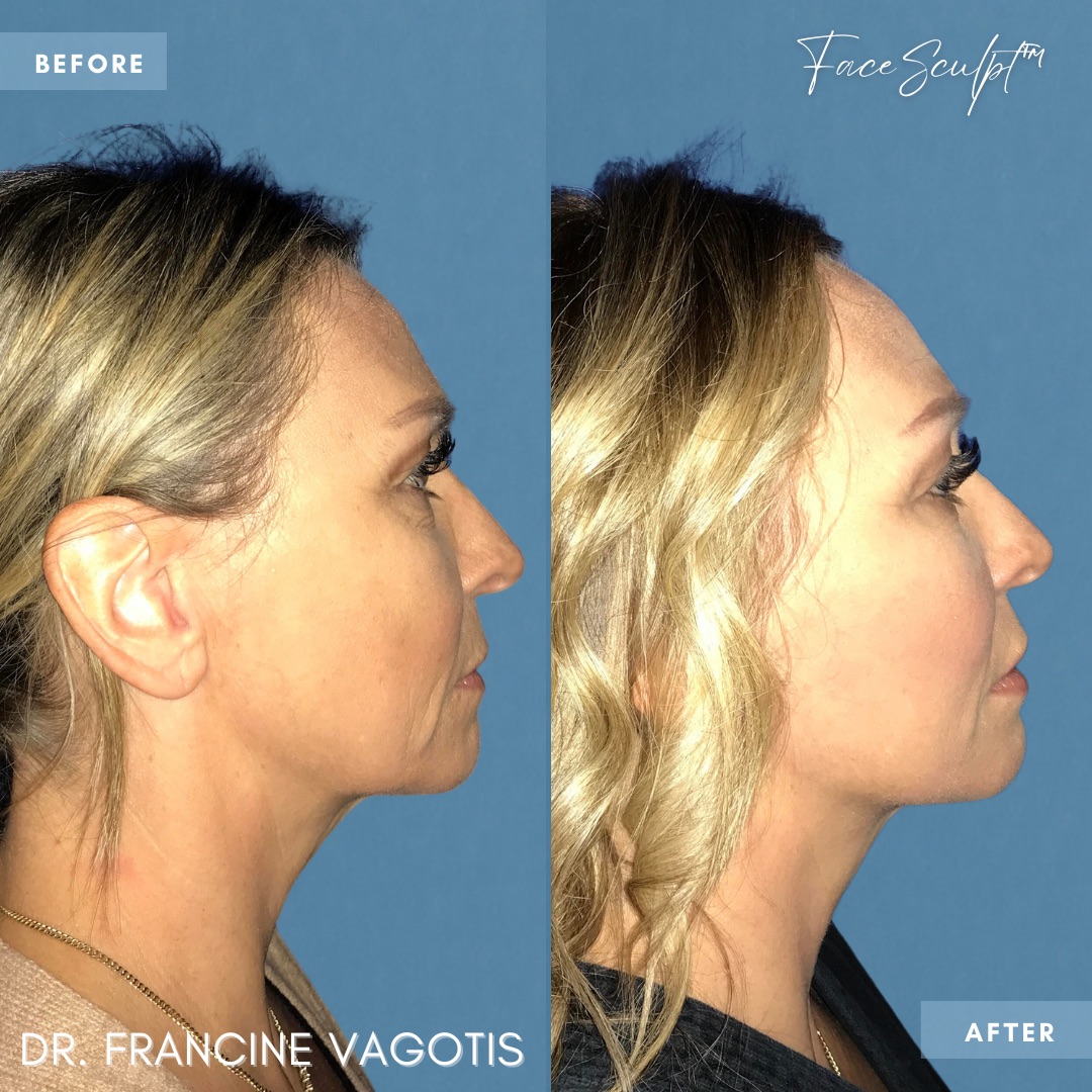 mini-facelift-surgery-before-after-dr-francine-vagotis-facesculpt-facial-plastic-surgery-chicago